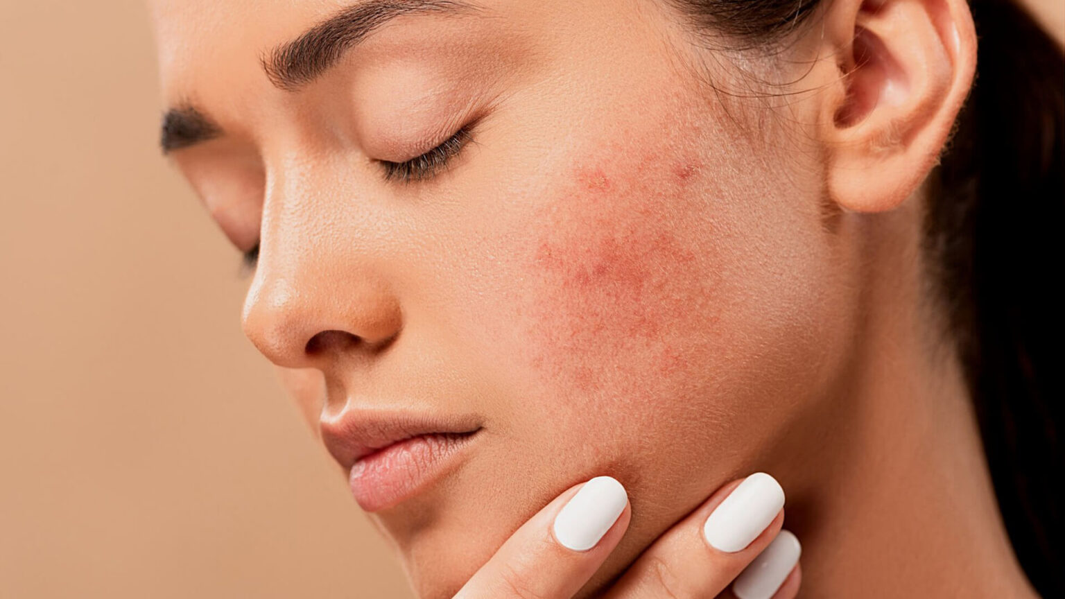 5 Dermatologist's Skin Care Tips for Rosacea 2024 Guide